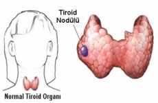 tiroit-nodulu.jpg