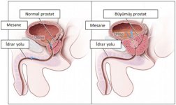 prostat_buyumesi2.jpg