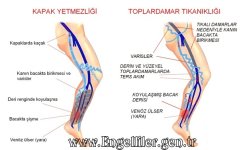 Venöz (toplardamar) yetmezlik nedir.jpg