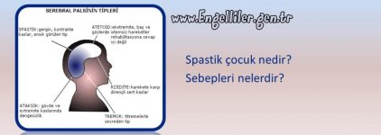 SEREBRAL PALSİ (CP - SPASTİK FELÇ).jpg