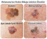 melanomanin-neden-oldugu-lekelere-ornekler.jpg