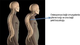 osteoporoz-2.jpg osteoporoz-2.jpg