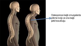 osteoporoz-2.jpg