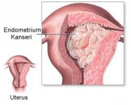 endometrium-kanseri.jpg