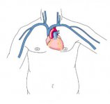 pacemaker-hamilyon.com_.jpg
