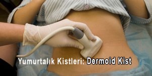 Yumurtalik-Kistleri-dermoid-kist.jpg