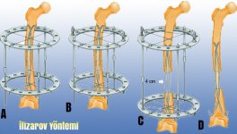İlizarov Yöntemi.jpg