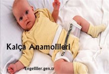 kalca-anomalileri.jpg kalca-anomalileri.jpg